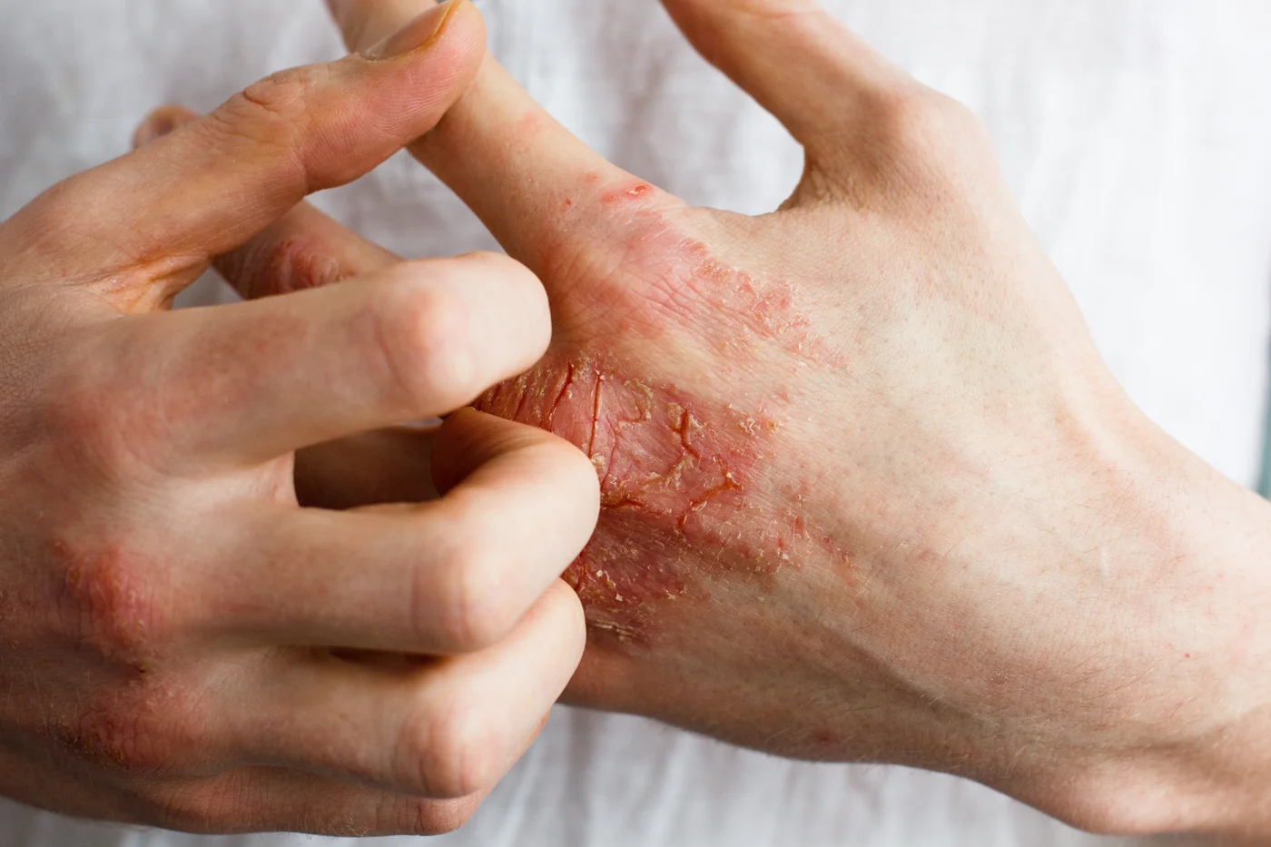 Eczema-two-in-Beachwood-OH.webp