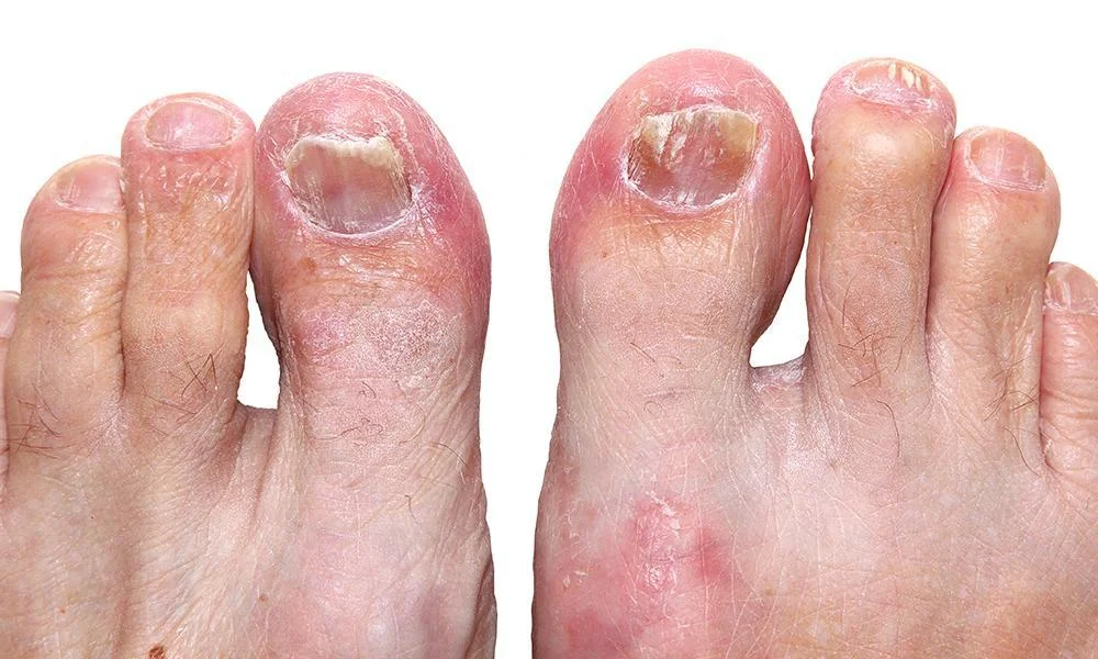 Fungal-Yeast-Infections-in-Beachwood-OH.webp