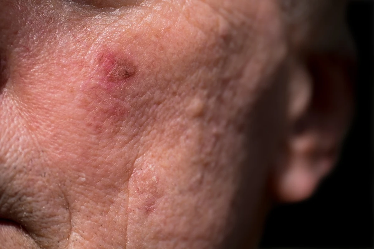 Keratosis-Service-in-Beachwood-OH.webp