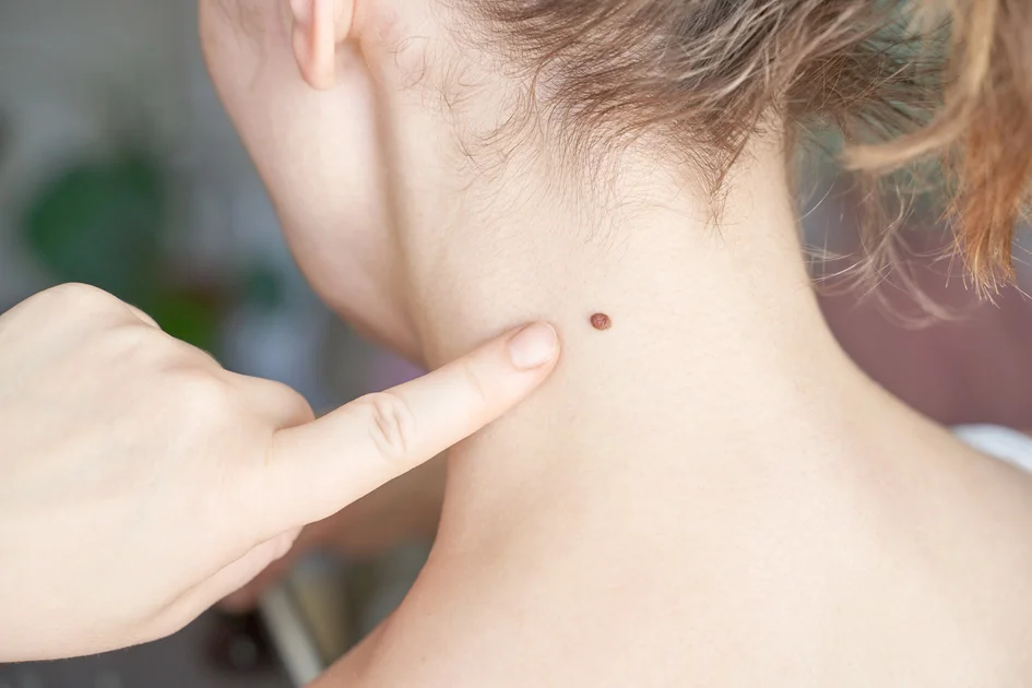 Mole-Removal-in-Beachwood-OH.webp
