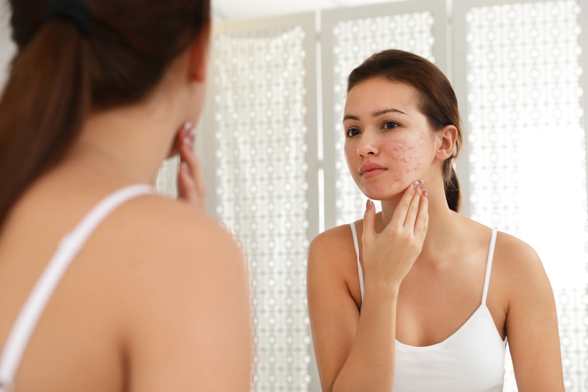 acne-in-Beachwood-OH.webp