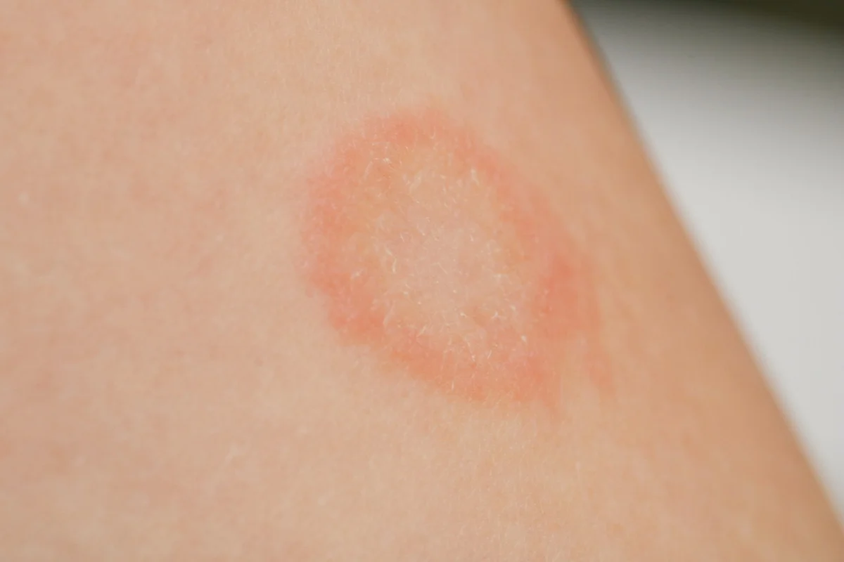 bacterial-skin-infections.webp