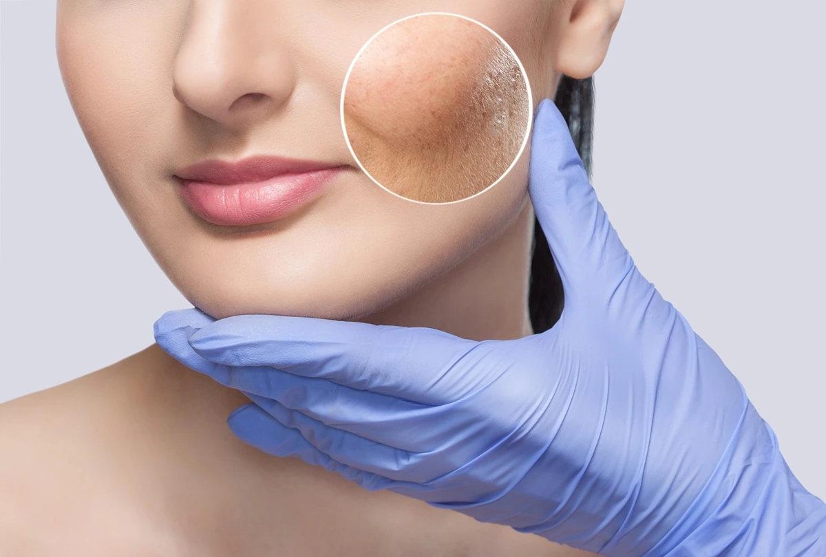 basal-cell-carcinoma-service-image.webp