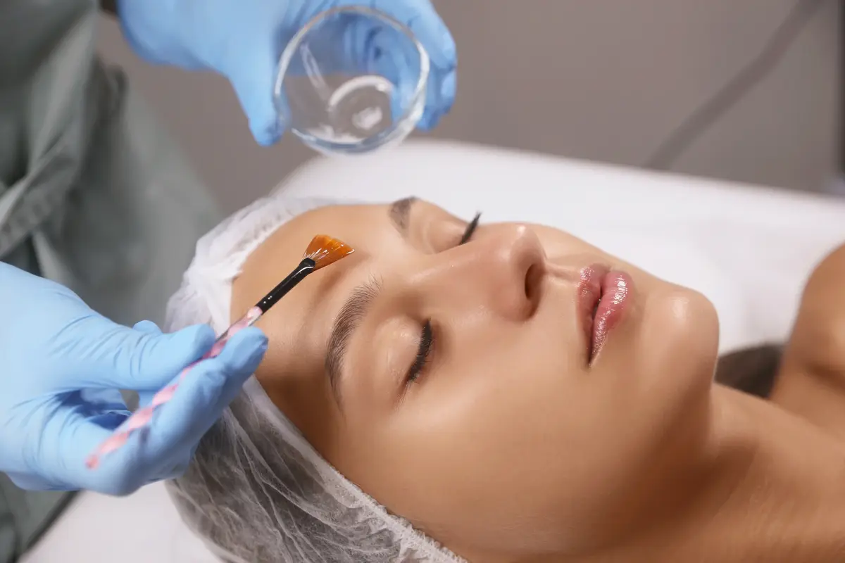 chemical-peels.webp
