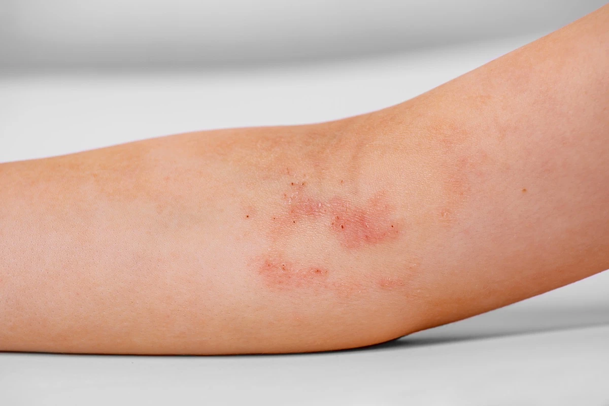 contact-dermatitis-treatments.webp