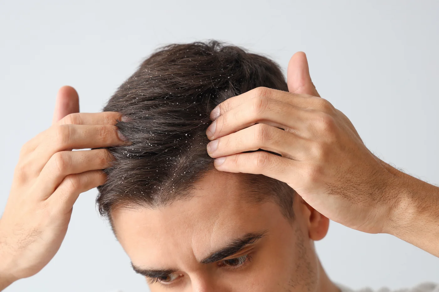 dandruff-in-Beachwood-OH.webp File type: image/webp