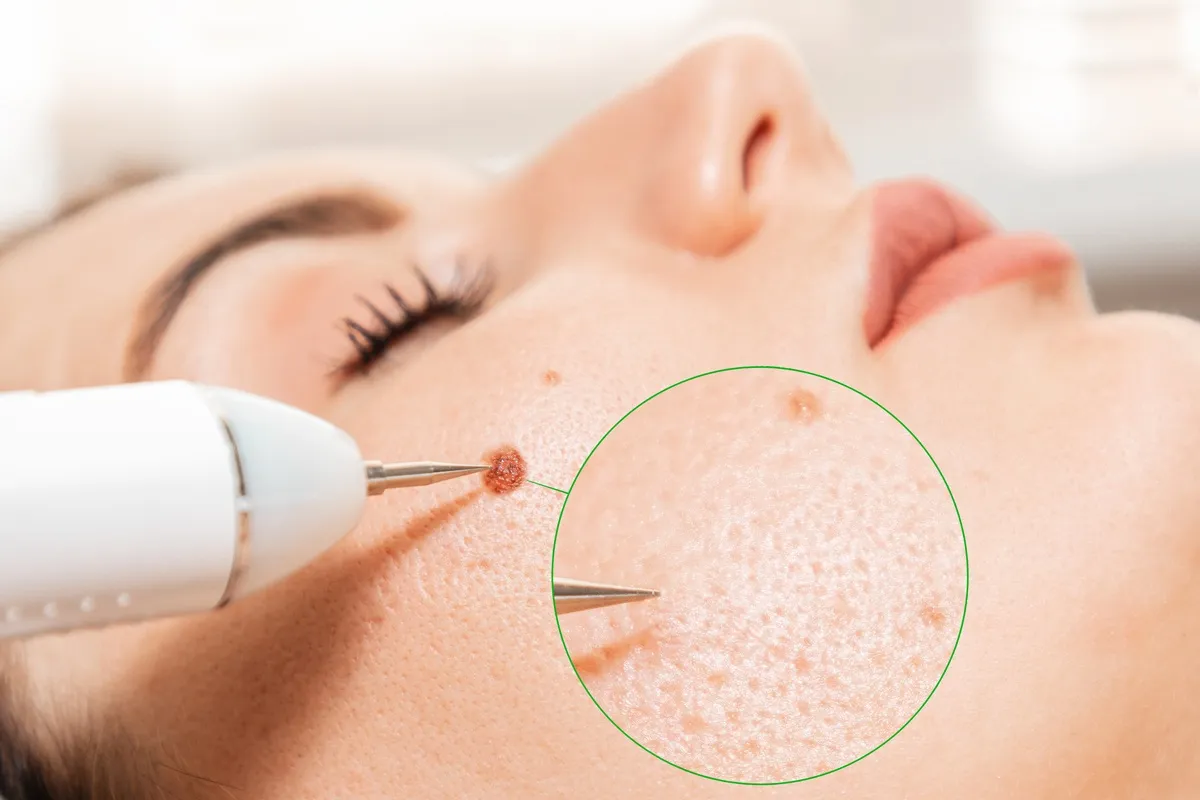 growths-and-lesions-birthmark.webp