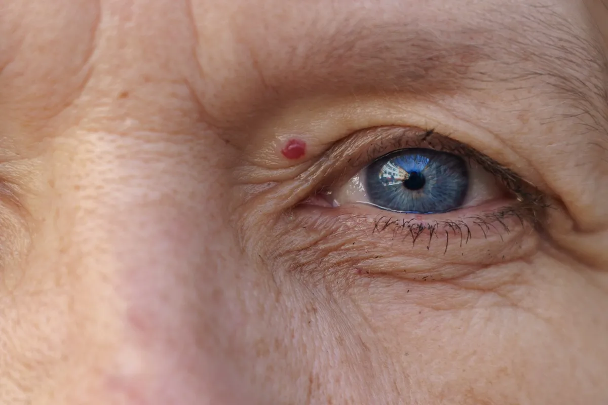 hemangiomas.webp