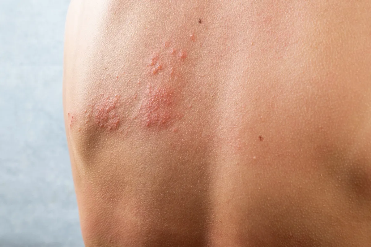 herpes-simplex.webp