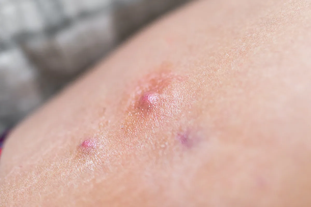 hidradenitis-suppurativa.webp