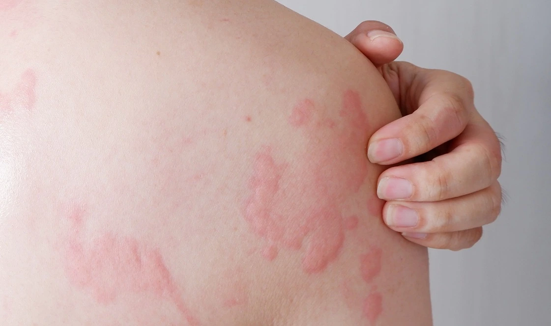 hives-urticaria-in-beachwood-oh.webp