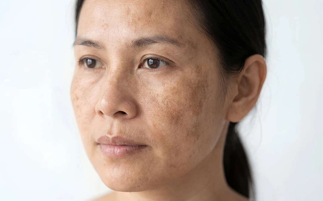 melasma-new-in-beachwood-oh.webp