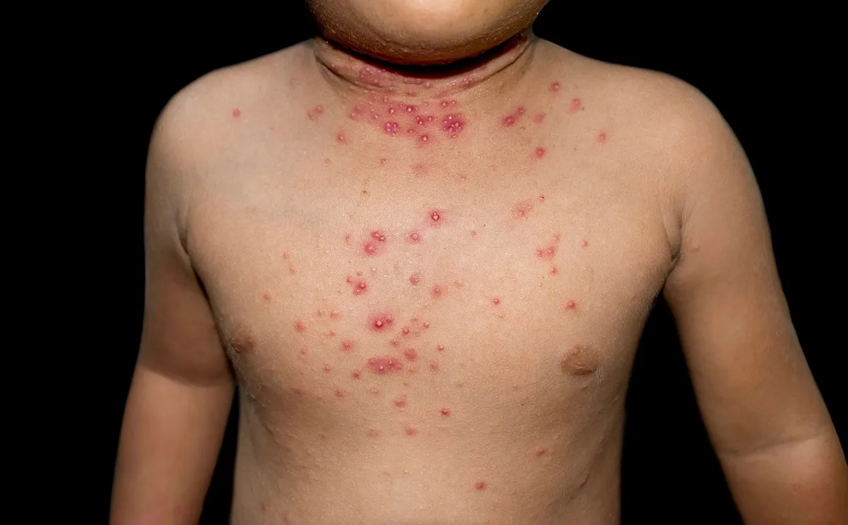 molluscum-contagiosum.webp