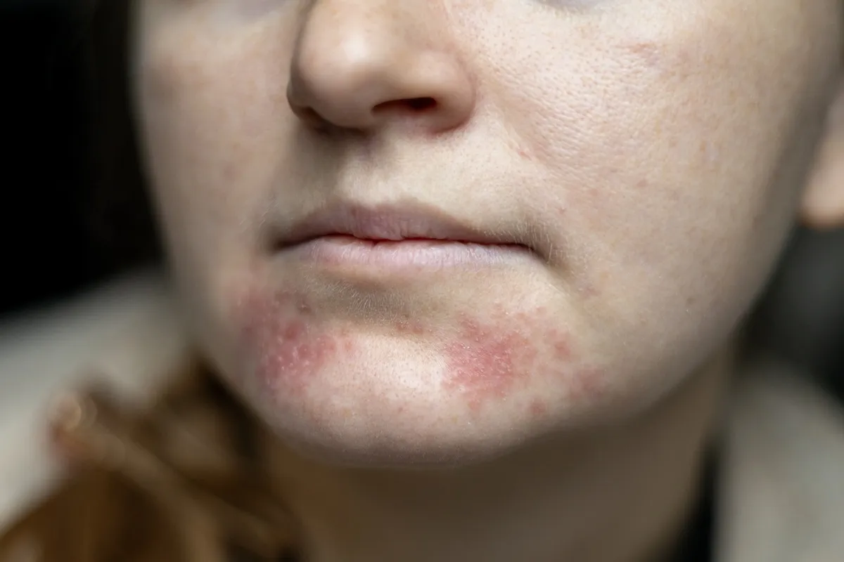 perioral-periorificial-dermatitis-treatments.webp