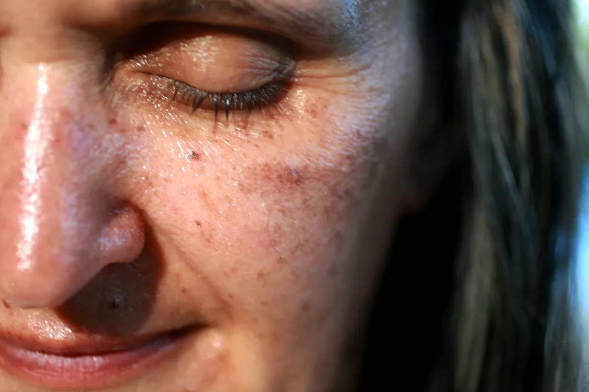 pigmentary-disorders.webp