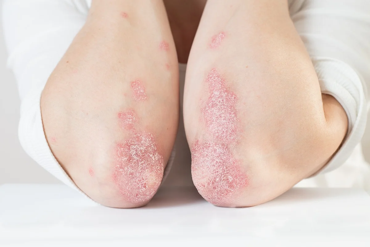 psoriasis-new-in-beachwood-oh.webp