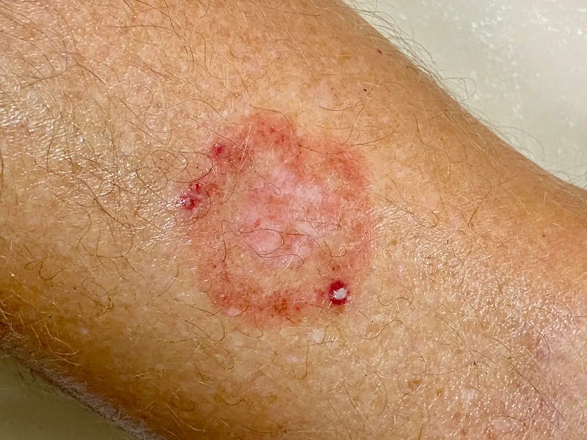 ringworm.webp