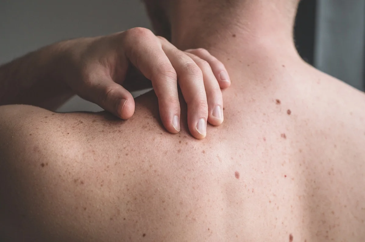 skin-cancer-treatments-new-in-beachwood-oh.webp
