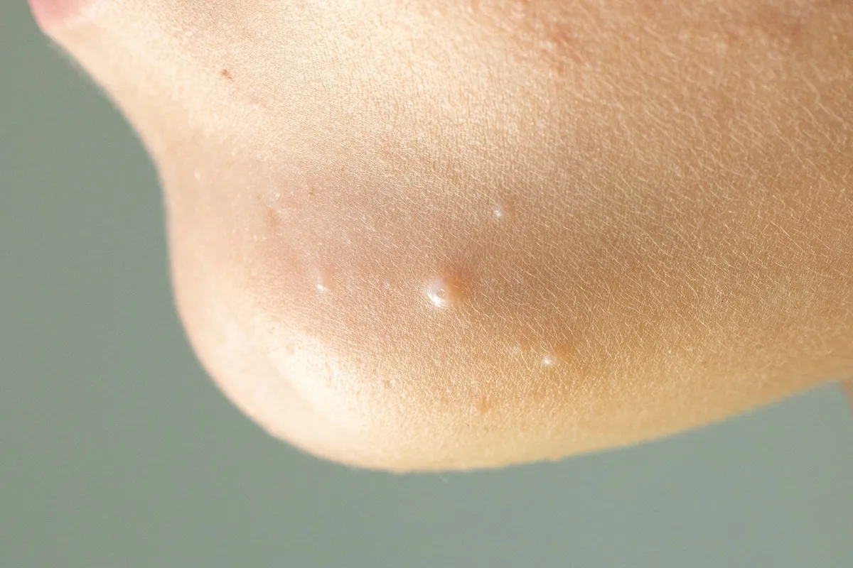 wart-and-molluscum-treatments.webp