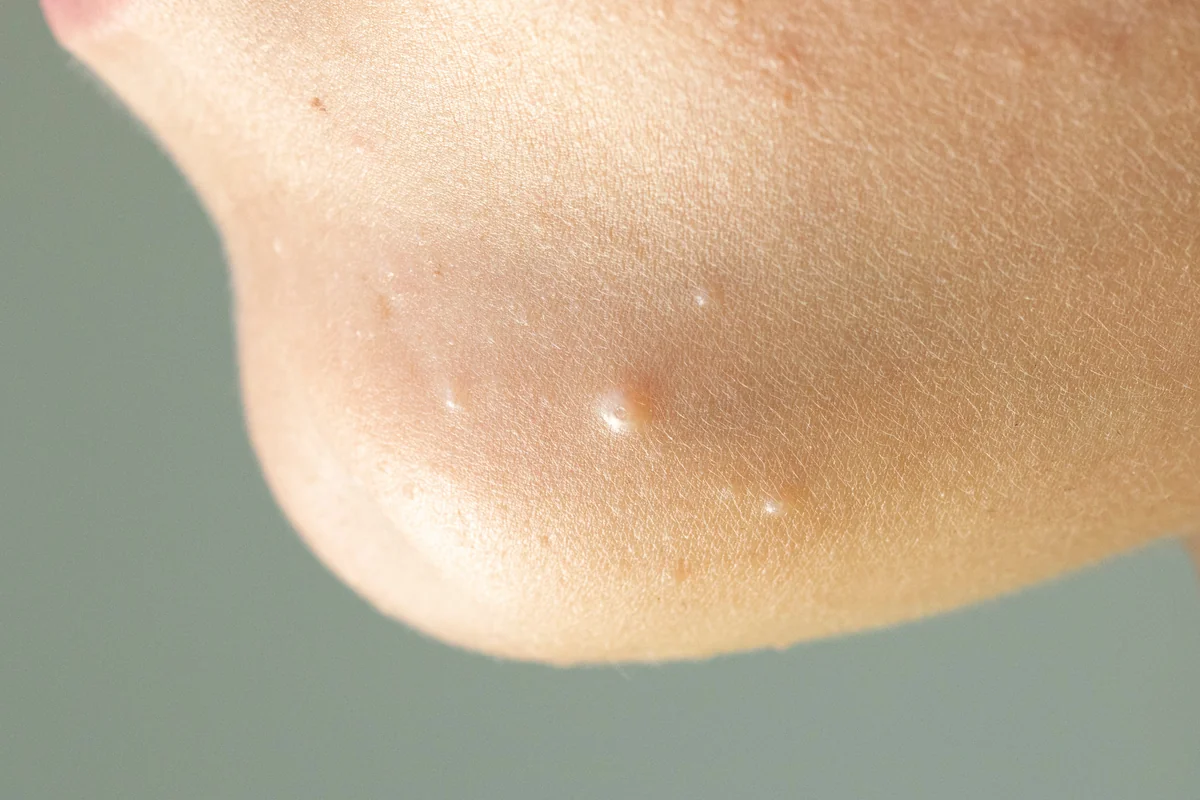 warts-in-Beachwood-OH.webp